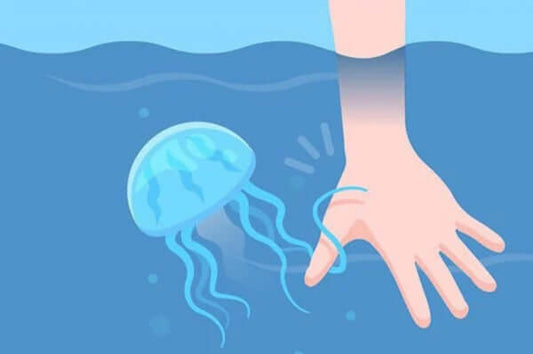 Jellyfish sting symptoms